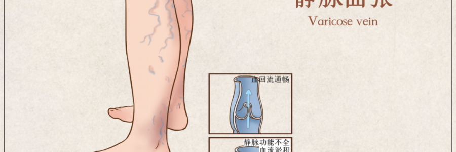 告別“蚯蚓腿”，靜脈曲張?jiān)趺凑{(diào)？