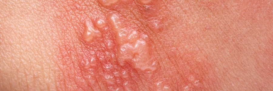 艾灸后起了小水泡，居然是邪氣在“逃跑”！